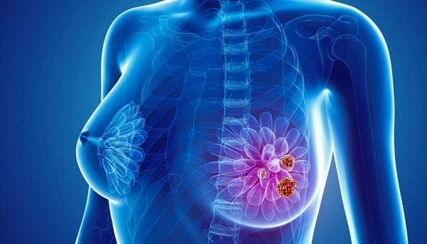 Ung thư vú đang gia tăng ở nữ giới trẻ tuổi