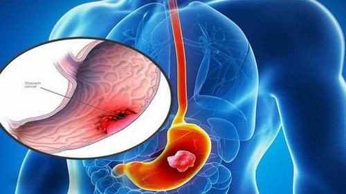 Ung thư dạ dày là bệnh nguy hiểm và có thể gây tử vong nhanh chóng nếu không được phát hiện và điều trị sớm