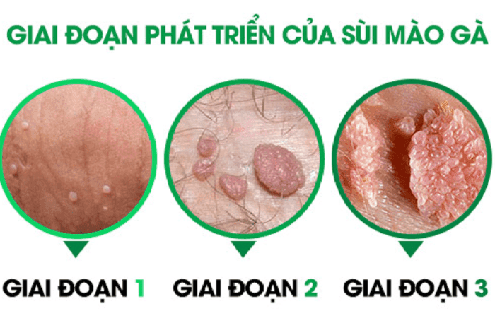 Các giai đoạn phát triển của sùi mào gà