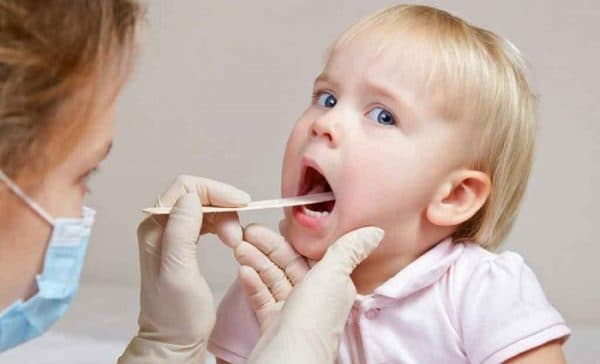 Viêm VA rất dễ gặp ở trẻ nhỏ.