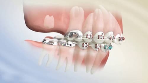 Niềng răng mắc cài gây vướng víu và kém tự tin cho nhiều người niềng răng