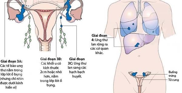 Ở giai đoạn cuối việc điều trị sẽ khó khăn do bệnh lây lan tới nhiều cơ quan khác nhau trong cơ thể