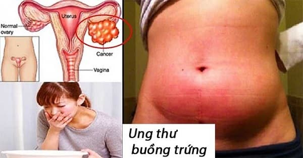 Ung thư buồng trứng giai đoạn cuối là giai đoạn nặng với các triệu chứng tại bụng và tại các vị trí di căn