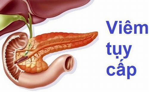 Các trường hợp viêm tụy cấp nặng cần nhập viện điều trị tại các đơn vị hồi sức tích cực, kết hợp theo dõi chặt chẽ. 