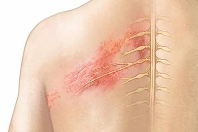 Bệnh zona thần kinh có lây không?