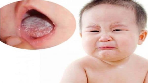 Nấm lưỡi là do một loại nấm men có tên Cadidan albicans có trong khoang miệng của trẻ gây ra
