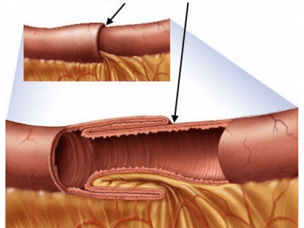 Lồng ruột ở trẻ em là gì?