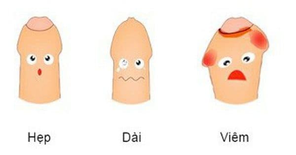 Viêm bao quy đầu ở trẻ em khiến cơ quan sinh dục của trẻ bị viêm đỏ, sưng tấy, đau rát, gây cảm giác khó chịu.