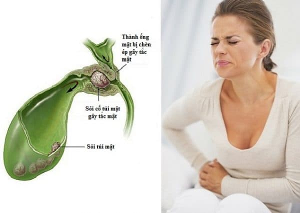 Những nguy hiểm từ bệnh sỏi mật