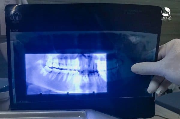 răng khôn gây nguy hiểm