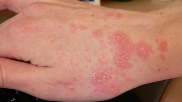 phòng khám Thu Cúc quận Cầu Giấy khám cà điều trị bệnh da liễu hiệu quả