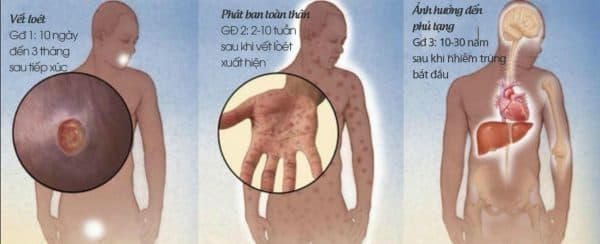 dấu hiệu bệnh giang mai