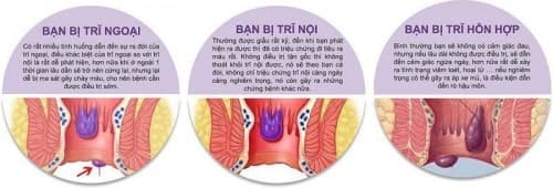 Bệnh viện Thu Cúc khám chữa và điều trị bệnh trĩ hiệu quả