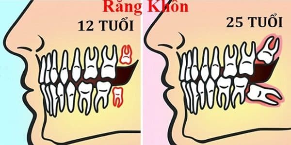 nhổ răng khôn có bị gì không