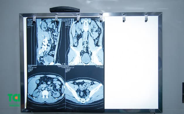 Chỉ định phẫu thuật nội soi tán sỏi niệu quản ngược dòng bằng laser