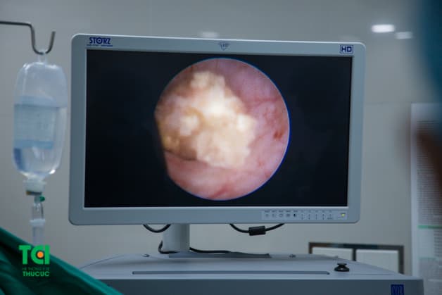 Nội soi tán sỏi niệu quản bằng laser được đánh giá là bước đột phá trong điều trị sỏi niệu quản.