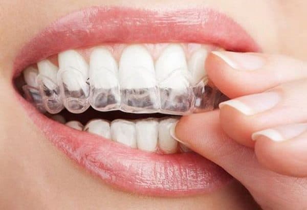 Niềng răng bằng phương pháp Invisalign