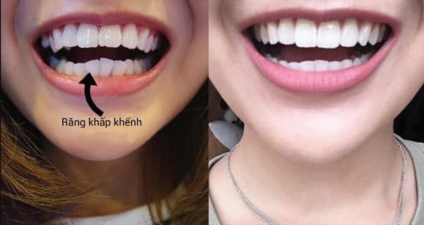 nẹp răng thẩm mỹ