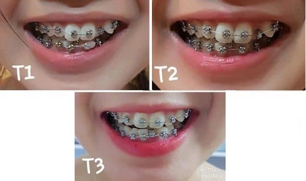 nẹp răng thẩm mỹ Thu Cúc