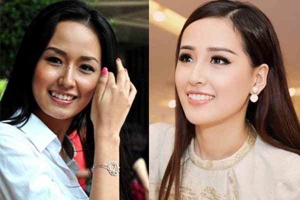 nẹp răng thẩm mỹ ở Thu Cúc