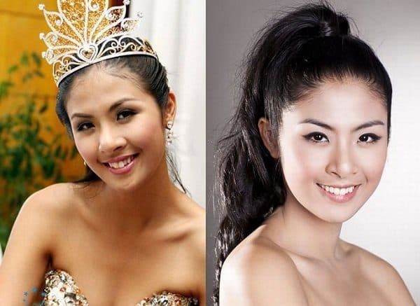 niềng răng mắc cài