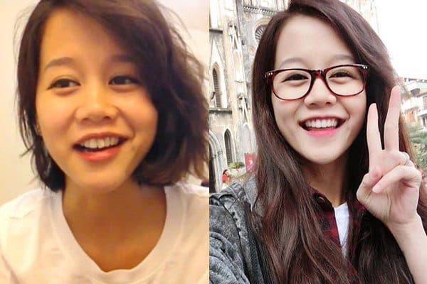 niềng răng mắc cài sứ