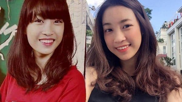 niềng răng Invisalign