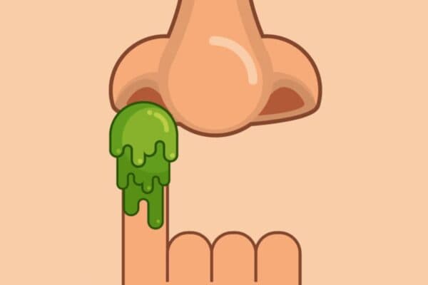 Ngoáy mũi sai cách có thể là nguyên nhân khiến niêm mạc mũi bị phù nề