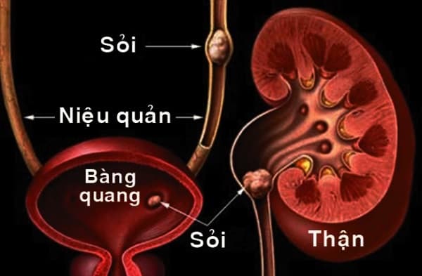 Hình ảnh mô tả sỏi niệu quản.