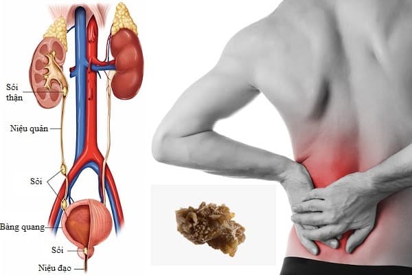 Hình ảnh sỏi tiết niệu trong hệ tiết niệu người.