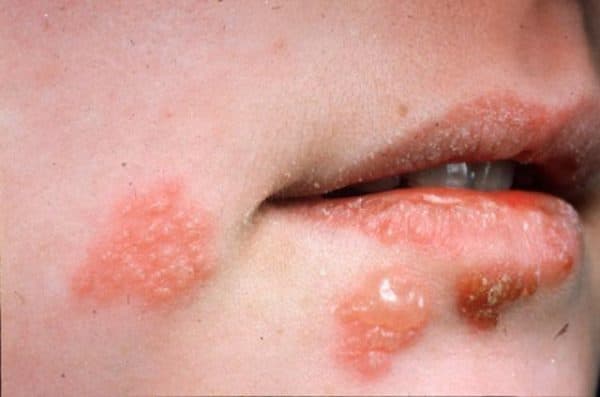 Bệnh herpes đơn dạng có thể gây các mụn rộp ở miệng