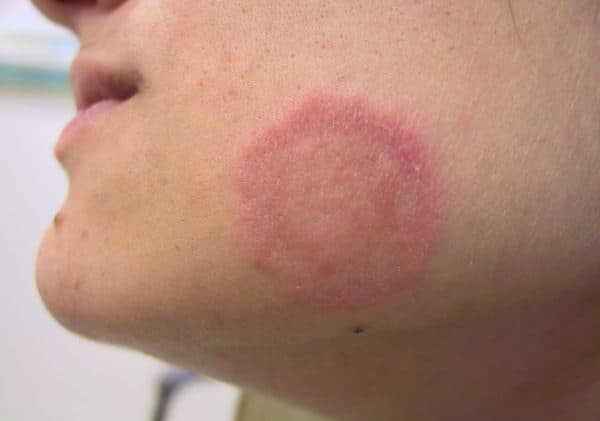 dấu hiện bệnh hắc lào