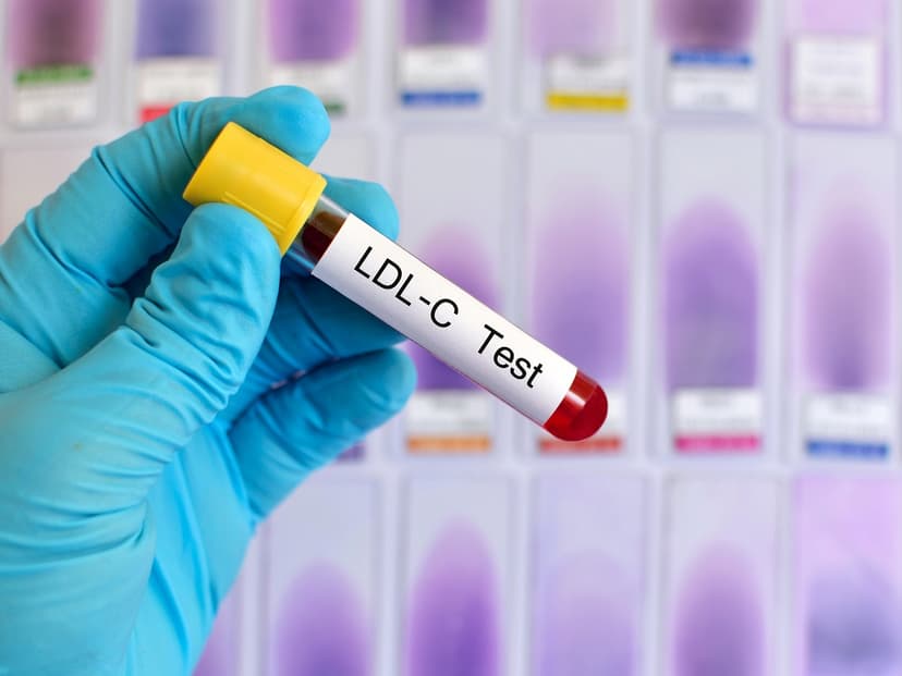 Định lượng LDL cholesterol là gì? Các yếu tố làm tăng