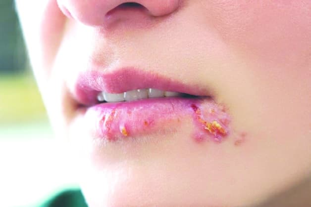 Virus herpes (HSV-1) gây mụn rộp ở môi