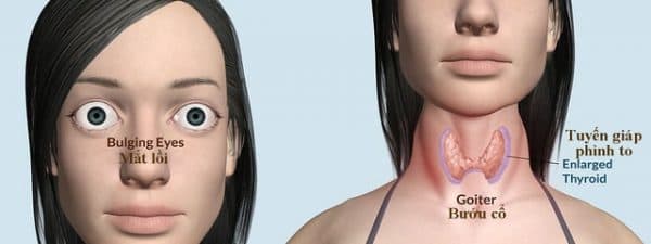 biểu hiện của bệnh basedow