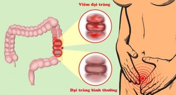 viêm đại tràng cấp gây đau đại tràng 