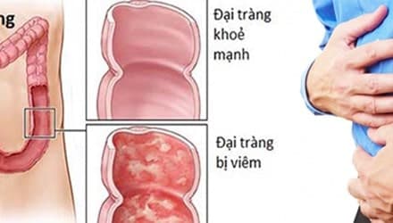 70-90% người bị đau đại tràng là do viêm loét đại tràng gây ra,
