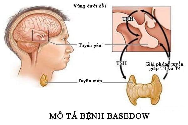 mô tả bệnh basedow