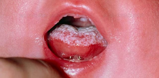 Điều trị đúng cách nấm miệng ở trẻ sơ sinh