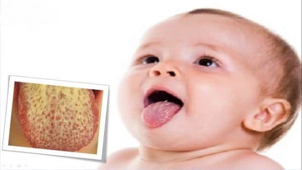 Các triệu chứng trẻ sơ sinh bị nấm lưỡi