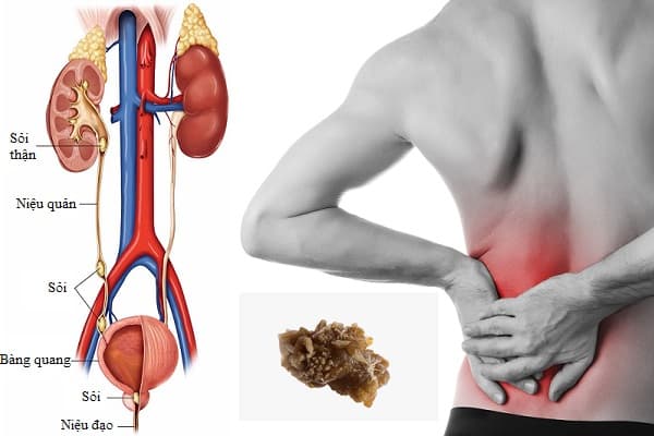 Sỏi niệu quản là gì?