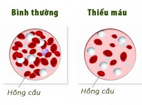 Hình ảnh mô tả bệnh thiếu máu ở trẻ em. (ảnh minh họa)