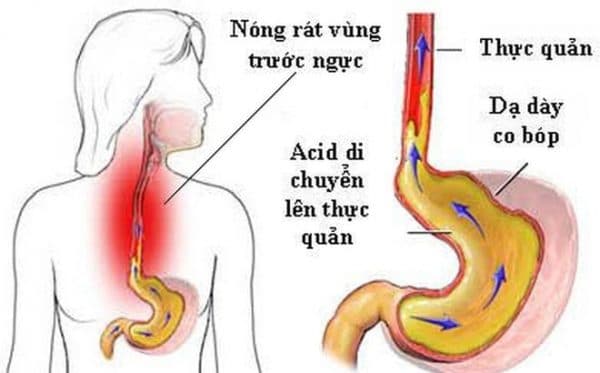 trào ngược dạ dày thực quản