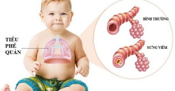 Viêm phế quản co thắt ở trẻ em rất nguy hiểm vì vậy ba mẹ cần nhận biết sớm và có biện pháp xử trí kịp thời.