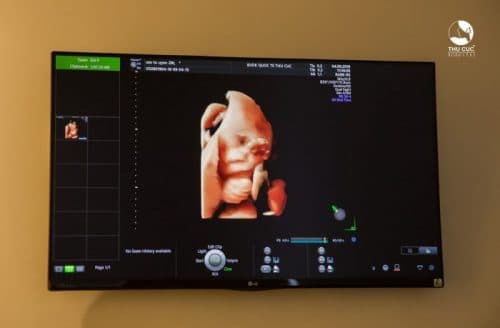 Hình ảnh siêu âm 5D