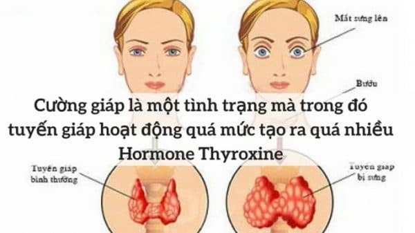bệnh cường giáp là gì