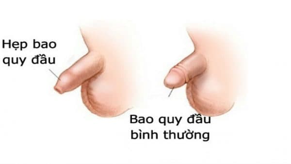 Trẻ bị hẹp bao quy đầu cũng cần phải có những can thiệp y khoa phù hợp (ảnh minh họa)