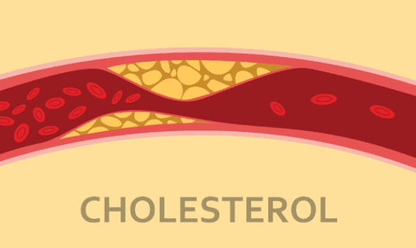 Cholesterol trong máu cao