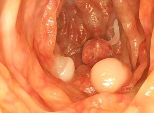 Làm thế nào để phát hiện sớm khối u trong đại tràng?