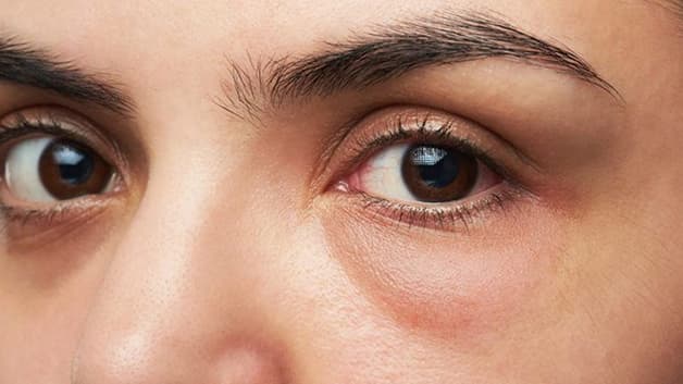 Mí mắt bị ngứa và sưng